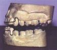 Mandibular Advancement Splint